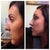 Profile before, 1 week after cast removal