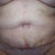 almost 2 weeks don't think I should be having skin rolls does anyone know about this? DR says it looks great??