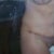 2 Week the lipo isn't even notice the indention in my side hoping it will even out 