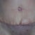 2 Week scare notice the center of the incision 