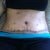 1 wk PO scar...