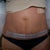 4 days post op mini tummy tuck