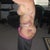 1 week post op