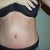 1 month post op.  Front view, looks pretty much like my 5 day post op, except I can stand straight now! Even with an infection and swelling, I am thrilled with the results so far.  Belly button is looking fine and doing okay, the triangular shape will relax in time.
