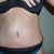 In this picture you can see the teeny tiny red mole that was way above my old belly button (which was higher before surgery and I am glad he moved it down a little, it looks more proportioned. Look where the red mole is now!
