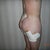 right side 3 days after fat transfer by Dr. Coleman