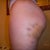 View of left side 6 days after transfer.