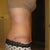 4 weeks- side incision