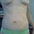 3 months post-op