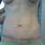 3 months post-op scar