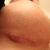 Close up of right side incision. Bulges in 2 areas. Not really sore, but scared of the scars that may be there.