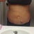 Day 2 morning stomach only- flanks and bra roll next week!