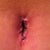 BB 2 weeks post op