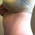 Week 5 - notice shadowing of my indent/crease on my hip. Hope it resolves.