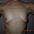 chest before nipple reduction and augment