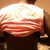 4 days post op back view