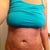3rd day. I see a difference!! bruises are starting to show.