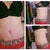 3 month mark... hopeful i continue to ease up on the love handles and that the scar tissue around the BB fades well.