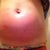 After procedure day 1 front view (really swollen, and you can see the by the redness that the applicator was a bit assymetrically placed)