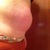 After procedure, day 1, side view. Looking pregnant in clothes.
