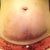 After procedure, day 2, front view bruising.