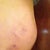 After procedure, day 2, side view bruising, still swollen.