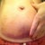 After procedure, day 2, trying to show the amount of skin (and fat) actually inserted in the suction device: A whole lot, maybe that's why it's so black n blue? Even my pubic area is noticeably swollen. And my bellybutton as well.