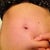 4,5 weeks. Noticing results :) The fat layer is definitely smaller. FYI: On all images where I pinch fat, I flex my stomach muscles to ensure that all I can pinch is the most superficial fat layer, so the images of the progress can be compared.