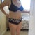 17 days post op. You can see a big difference already!!