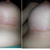 Scar under breasts 12 days