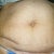 Before Picture.  As difficult as it is to post a picture of my stomach it's something I must do for all to understand why I went through with the Tummy Tuck surgery.  I have scars from having had two c-section and my appendix removed.  I also have strecth marks gallore, after having twins at a very young age.