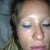 6 hours after injections....swelling