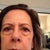 Before..note even the lower eyes are improved in after shot and procedure was only upper and mini.