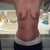 Before- huge areolas, like fried eggs