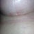 Incision that is doing really well 15 days post-op
