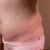 Left hip - this side looks the worst to me - pic looks even worse and this was evening shot kind of pull