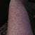 gross... My freckles were very light. But after this first IPL they all came out dark & raised up.. started peeling off brown spots.