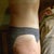 6 months post OP
