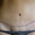 6 months post OP