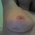 Scar is still tethered, but only visible when arm is lifted. It is still very dark, so it looks deeper than it is.
