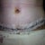 Day 4, post op