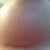 Incision at 4 weeks postop. The cream I'm putting on will be used 2x a day for 6 months.