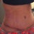 3 weeks post op