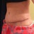 3 weeks post op