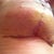 Right, 3 weeks - a bit of skin irritation from the tape