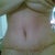 Three Weeks after surgery 12/10/2011