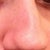 Right view at an angle before - this is the bulbous nostril that will be removed
