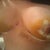 Day 6 post op