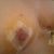 Day 6 post op - side view
