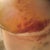 Day 6 post op - Left side, lots of bruising